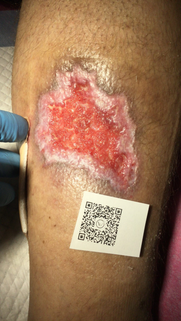 venouse leg ulcer treatment
