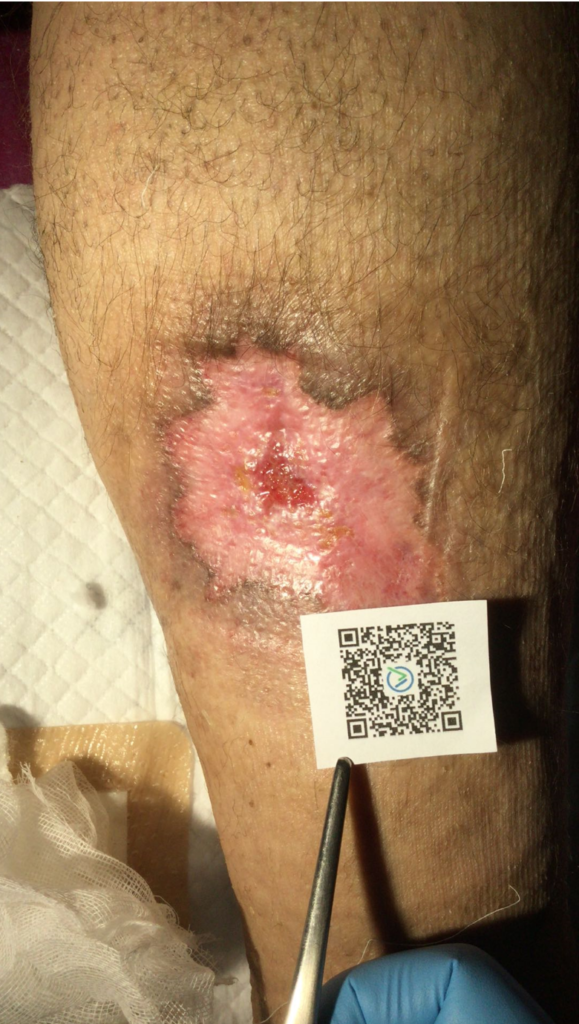 venouse leg ulcer treatment