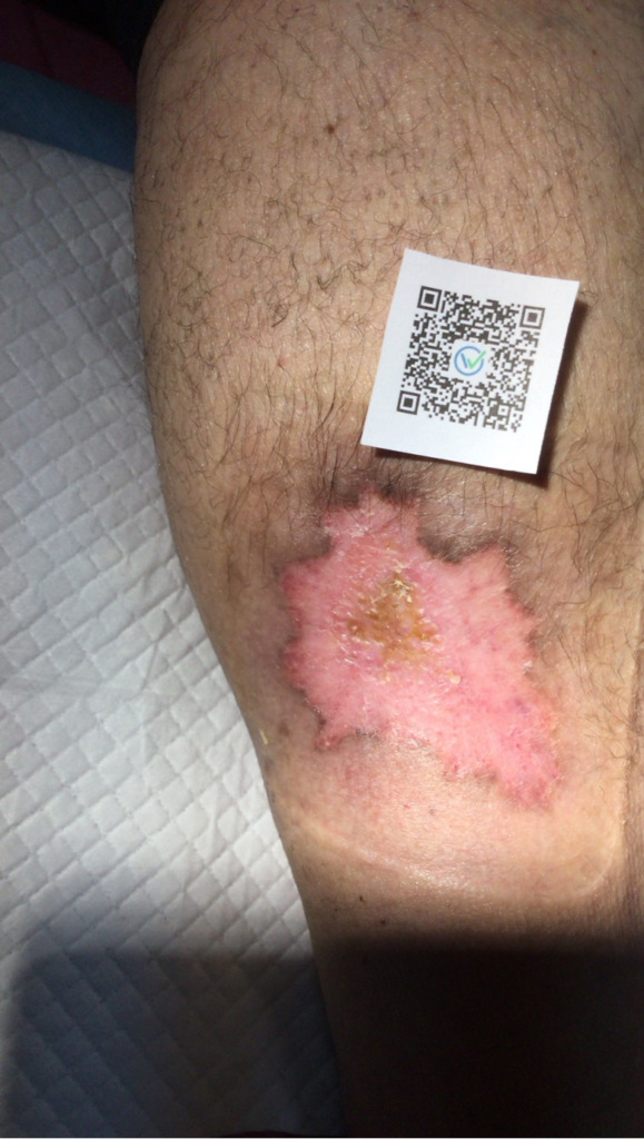 venouse leg ulcer treatment