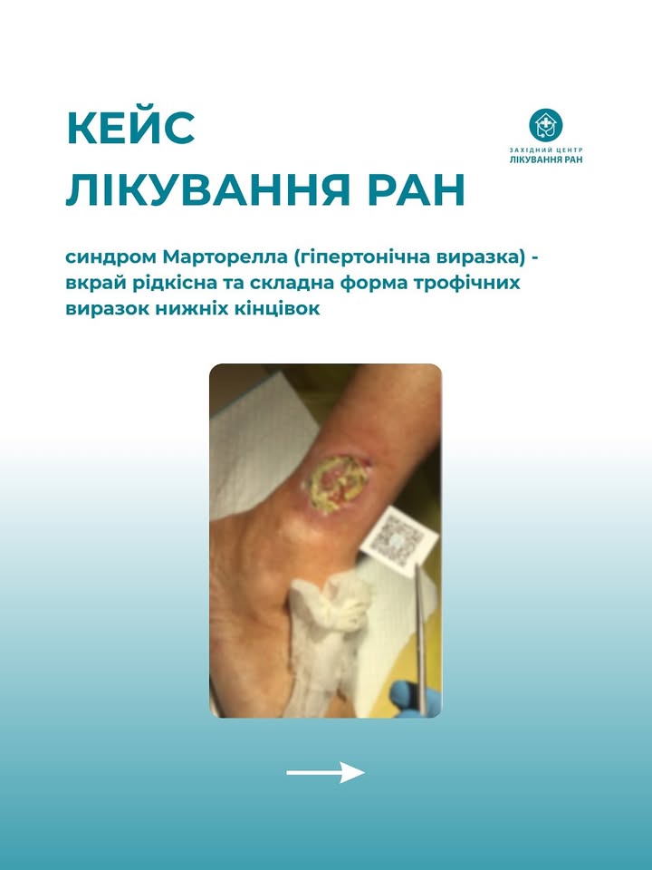 Західний центр лікування ран